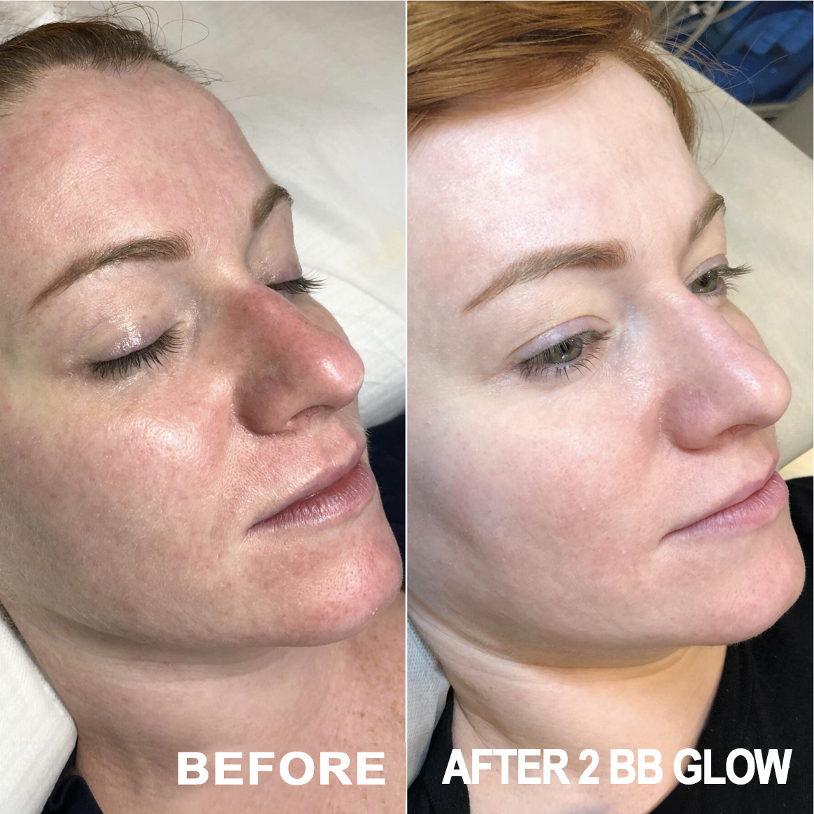 BB GLOW FACIALS