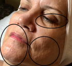 BEFORE MICRONEEDLING w/ BIOLIGHT THERAPY