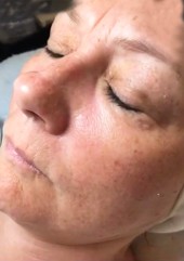 before hydro luxe rejuvenating facial before hydro luxe rejuvenating facial