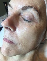 Before Microneedling Series of 6