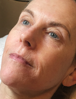 AFTER SERIES OF 6 BOTANICAL STEM CELL THERAPIES