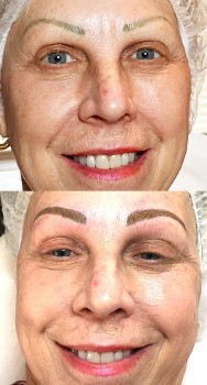 Before & After Corrective Microblading