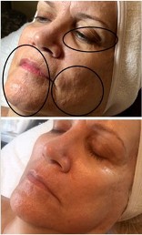 Microneedling Before & After