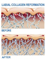 Labial Collagen Reformation