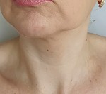 neck only view of before mesenchymal stem cell neck lift 