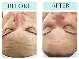 Hydra Dew Pure Facial Before & After Hydra Dew Pure Facial Before & After