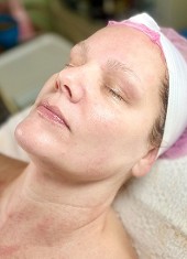 After Stem Cell Revival Facial