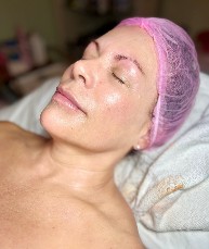 After Stem Cell Skin Rejuvenation