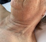 neck only view of before mesenchymal stem cell neck lift 