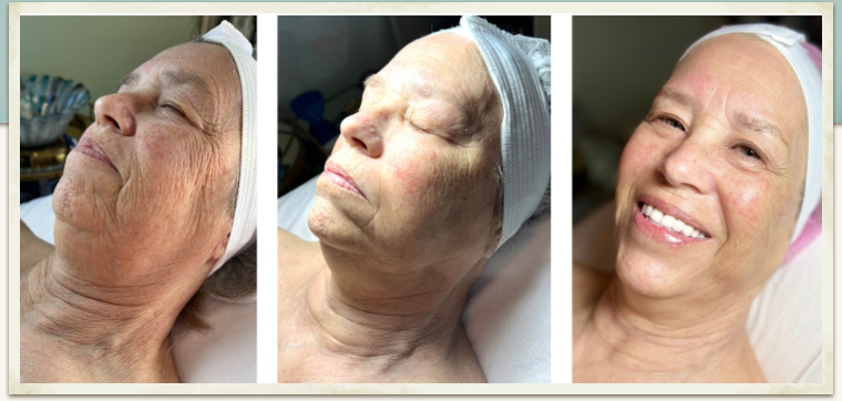 Botanical Stem Cell Skin Rejuvenation
